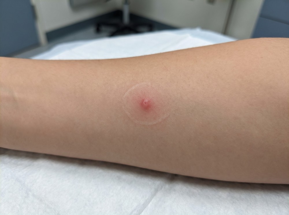 Close-up of a small red swollen bite mark on forearm skin resembling a mild bee sting reaction
